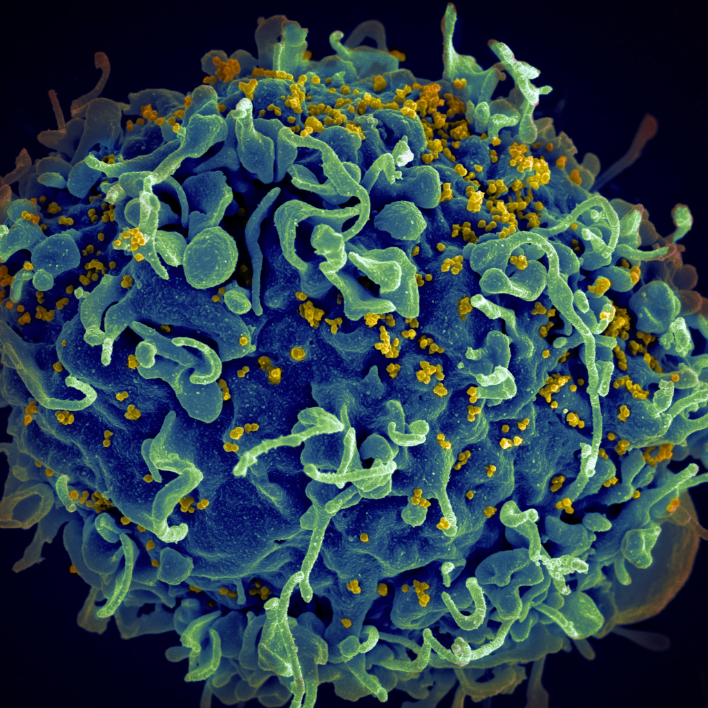 Η πρώτη γυναίκα που θεραπεύτηκε από τον HIV με μεταμόσχευση βλαστοκυττάρων είναι γεγονός