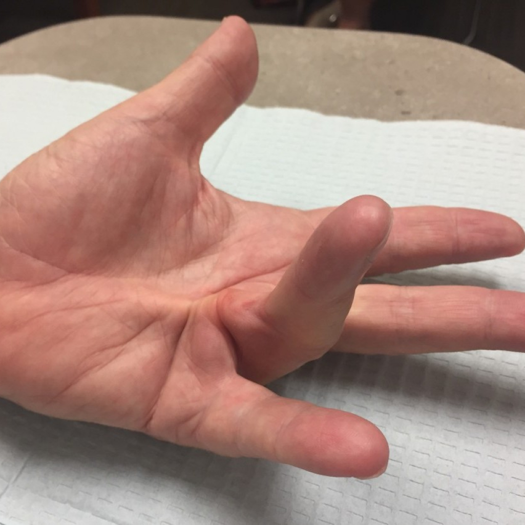Νόσος Dupuytren: Η πιο κοινή (και ύπουλη) πάθηση των χεριών που δεν ξέρεις