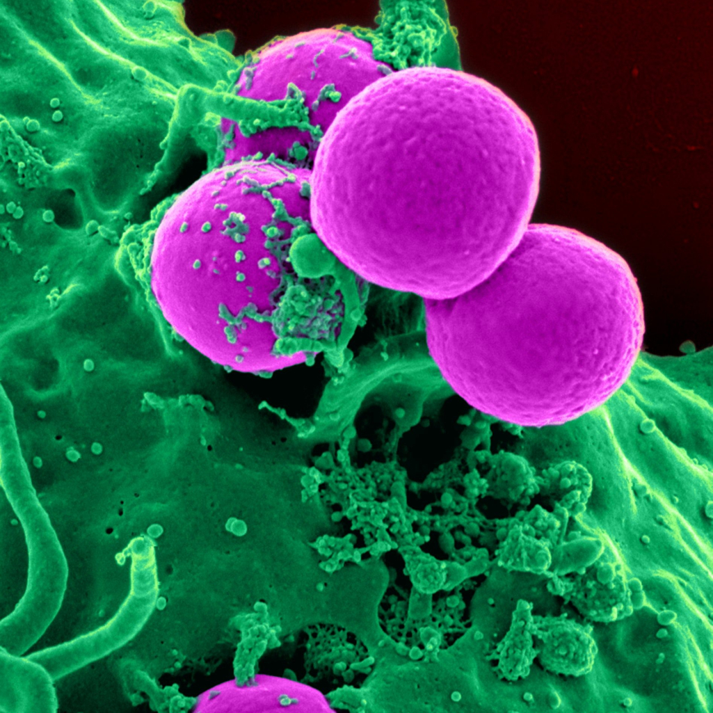Τι είναι η βακτηριακή λοίμωξη που έστειλε τη Μαντόνα στην εντατική - Οι αιτίες και τα συμπτώματα