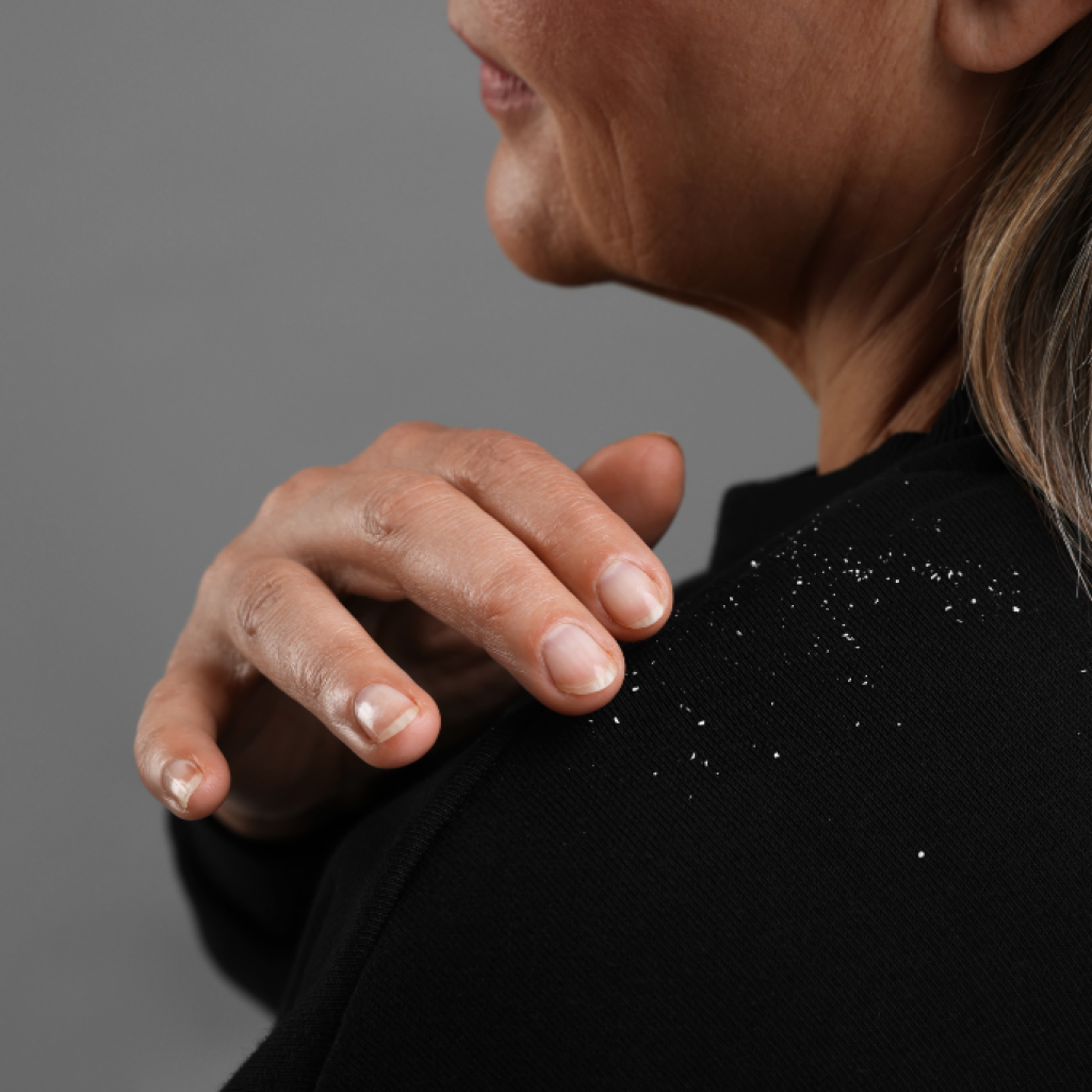 Ξηρά μαλλιά και πιτυρίδα: Πώς να επιλέξεις το σωστό σαμπουάν για άμεση ανακούφιση