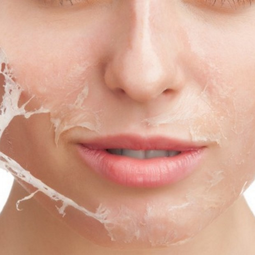 chemical-peel-philadelphia.jpg