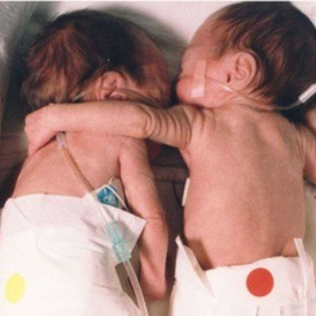 "The Rescuing hug": Η υπόθεση των πρόωρων διδύμων που σώθηκαν με μια αγκαλιά πριν 25 χρόνια