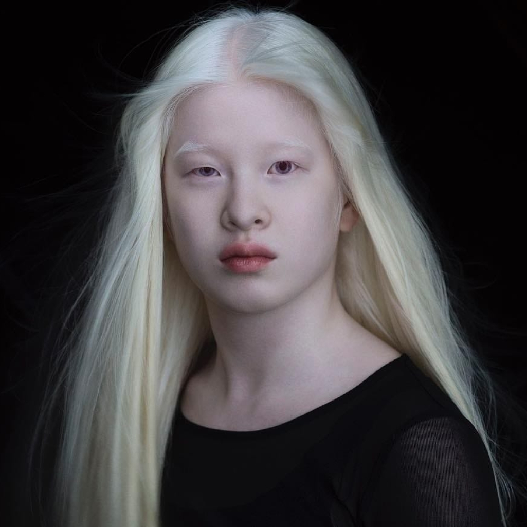Xueli Abbing: Το μοντέλο με αλμπινισμό που από το ορφανοτροφείο βρέθηκε στις σελίδες της Vogue