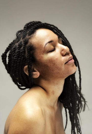 Η Harrys Taylor είναι η φωτογράφος που αναδεικνύει την ομορφιά γυναικών με εμφανείς δερματικές παθήσεις
