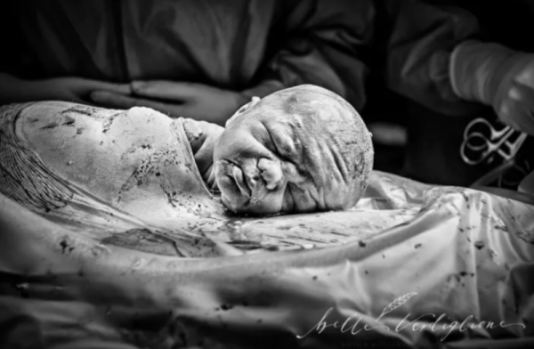 Η γέννηση ενός μωρού, μέσω καισαρικής.
Belle Verdiglione Photography / Via belleverdiglionephotography.com.au
