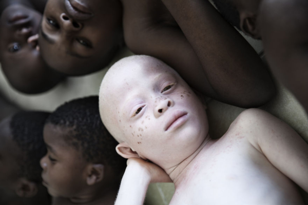 Το δέρμα και τα μάτια τους είναι χωρίς χρώμα, πράγμα που σημαίνει ότι δεν έχουν φυσική προστασία από τον σκληρό αφρικανικό ήλιο. 