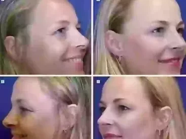 Πείραμα: 20 χρόνια Botox vs. 20 χρόνια χωρίς - Η συγκλονιστική διαφορά ανάμεσα σε δύο δίδυμες