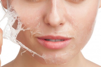 chemical-peel-philadelphia.jpg