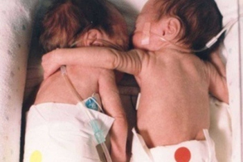 "The Rescuing hug": Η υπόθεση των πρόωρων διδύμων που σώθηκαν με μια αγκαλιά πριν 25 χρόνια